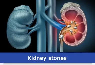 kidneystones