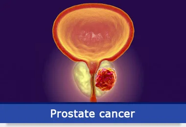 prostate-cancer